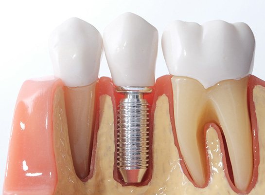 Glossy sample implant in model jaw