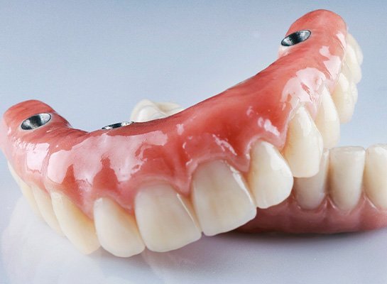 A set of implant dentures