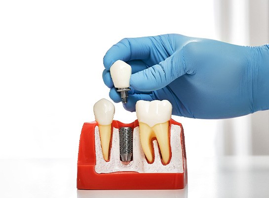 Gloved hand placing abutment onto model dental implant