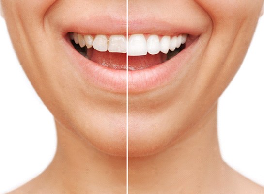 Closeup of patient's smile before and after veneers