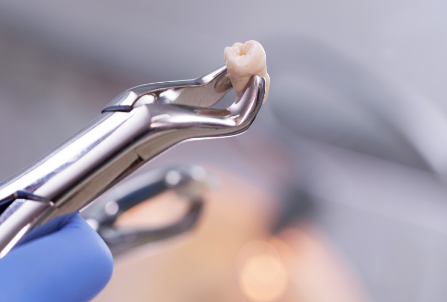 Extracted tooth on forceps