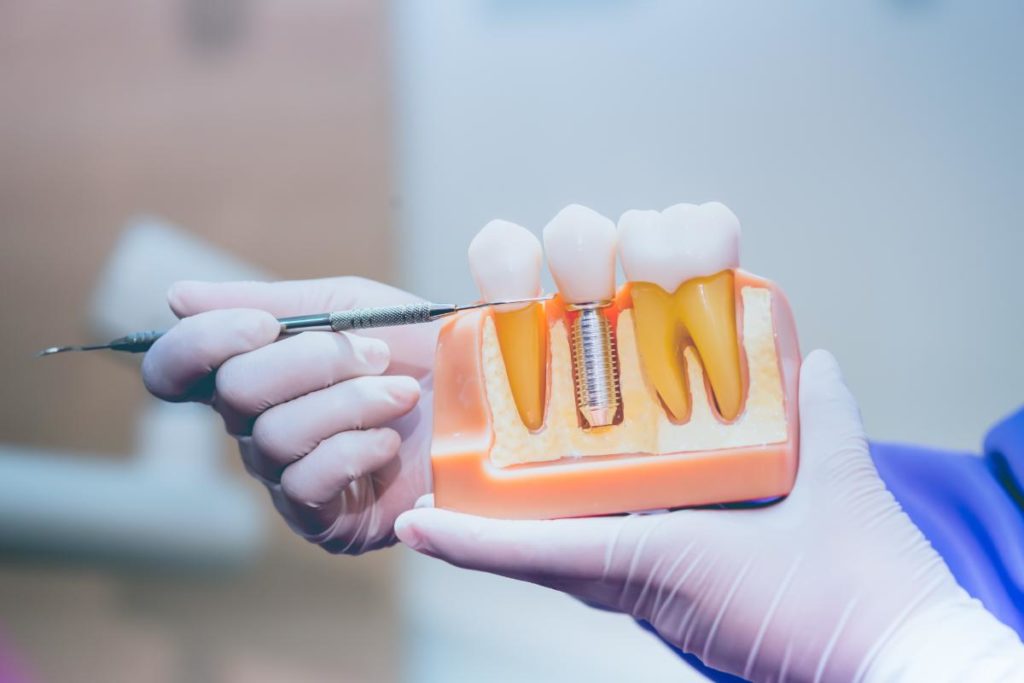 dentist-showing-types-of-dental-implants
