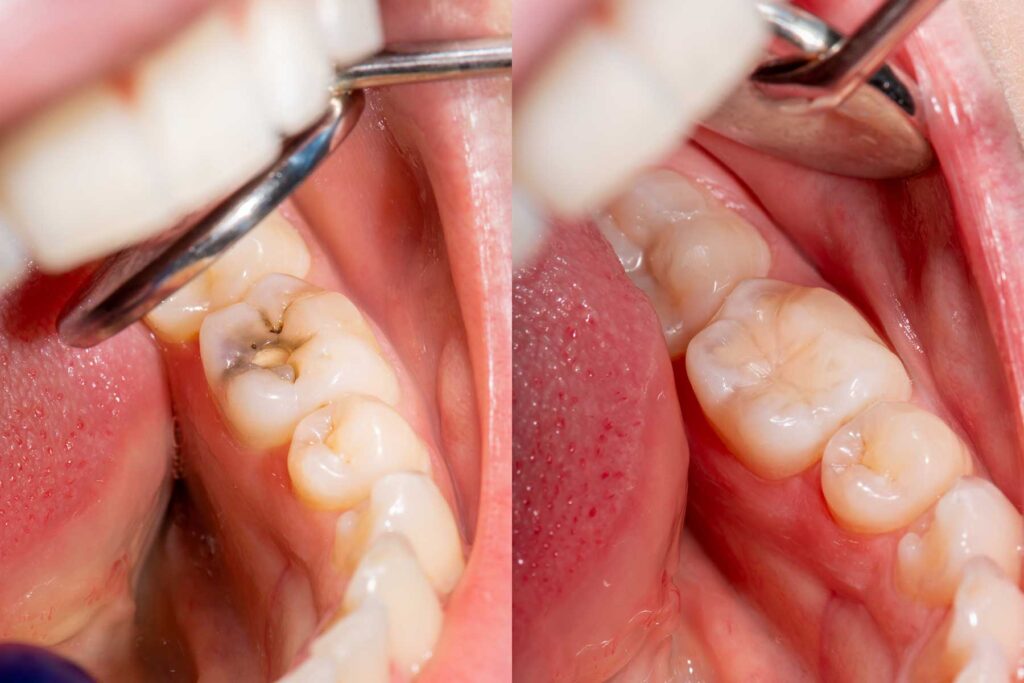 a photo of a dental patient's mouth open showing teeth that need restoration while dentist explains to patient the length of tooth restoration